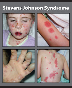 ستيفنز جونسون متلازمة متلازمة ستيفنس