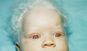 Albinism 408425.jpg